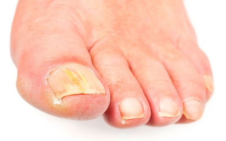 The reasons for the fungus