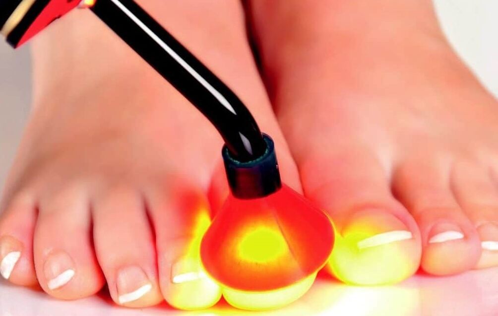Laser treatment of nails
