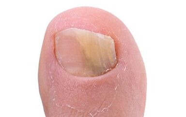 Symptoms of the presence of fungi on the thumb of the leg