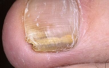 manifestations of the fungus on the thumb of the leg