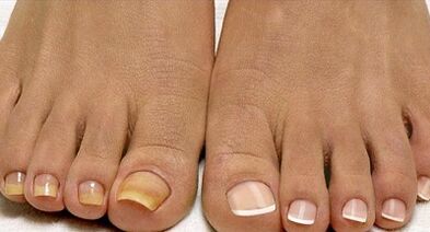 Methods for the treatment of fleet fungi