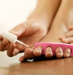 Application of therapeutic lacquer