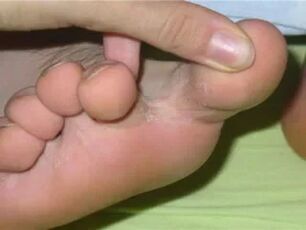 Toe