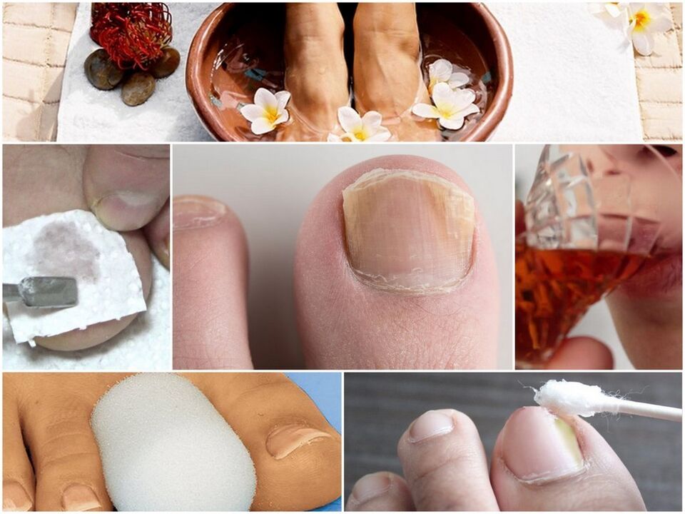 Nail fungus treatment