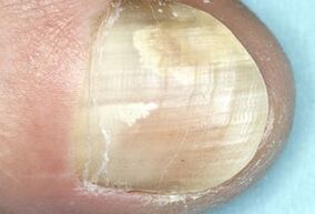 Nail damage due to a fungal infection