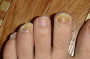 Yellowing of the nail due to fungi