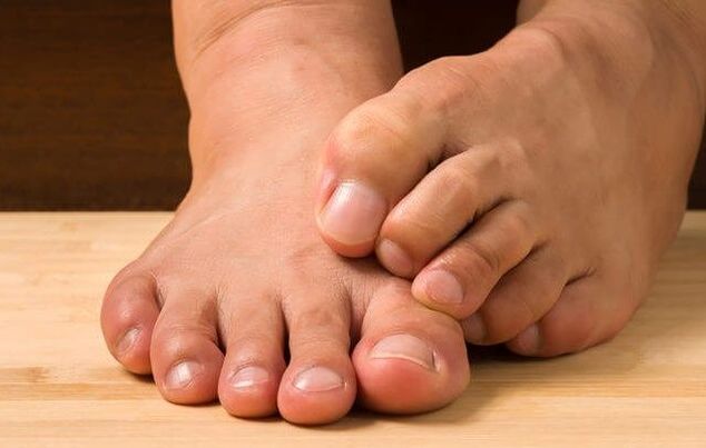 foot fungus and remedies for the same