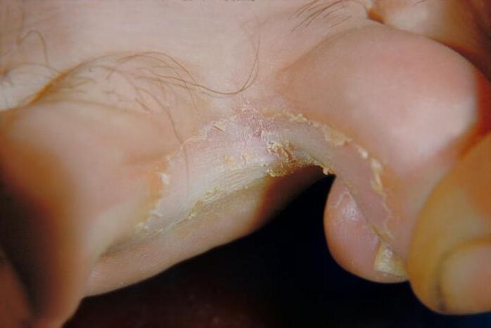 fungus between the toes