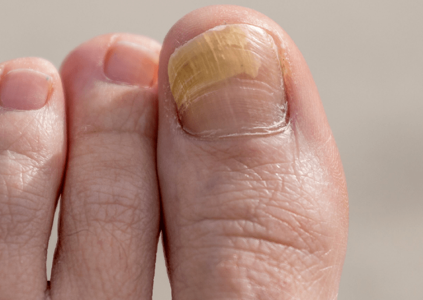 fungus on the nails of the big toe